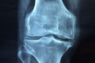 An xray of a knee